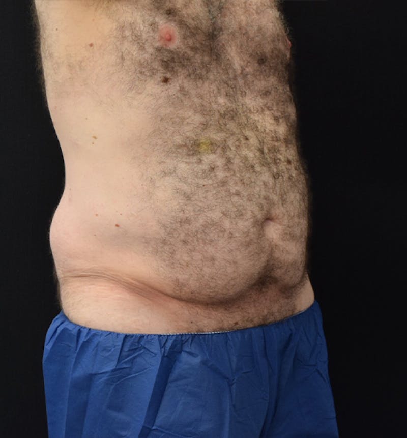 Male Lower Body Lift Before & After Gallery - Patient 148037529 - Image 7