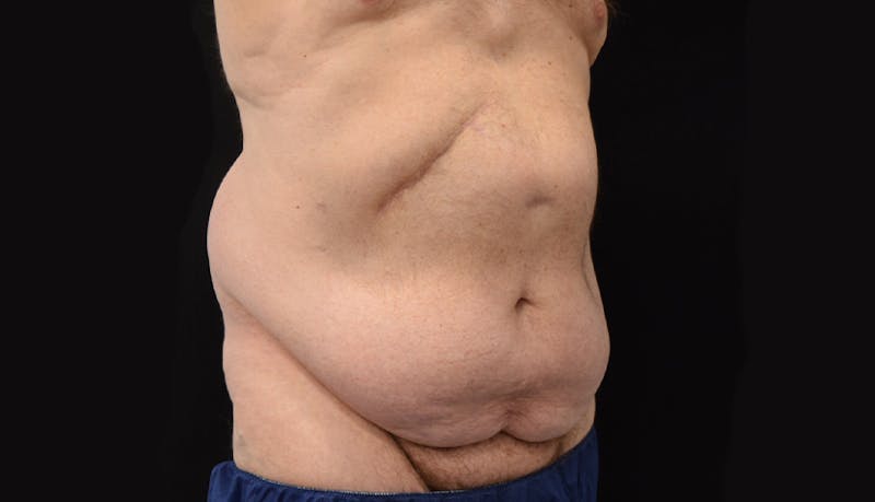 Massive Weight Loss Gallery - Patient 102563759 - Image 7
