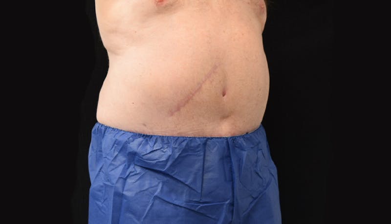 Massive Weight Loss Before & After Gallery - Patient 102563759 - Image 8