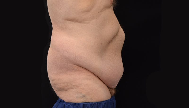 Massive Weight Loss Before & After Gallery - Patient 102563759 - Image 9