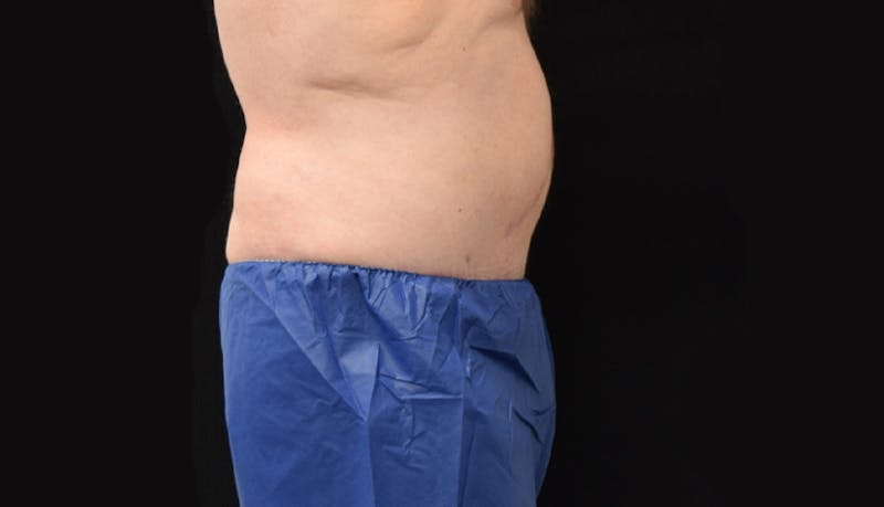Massive Weight Loss Before & After Gallery - Patient 102563759 - Image 10