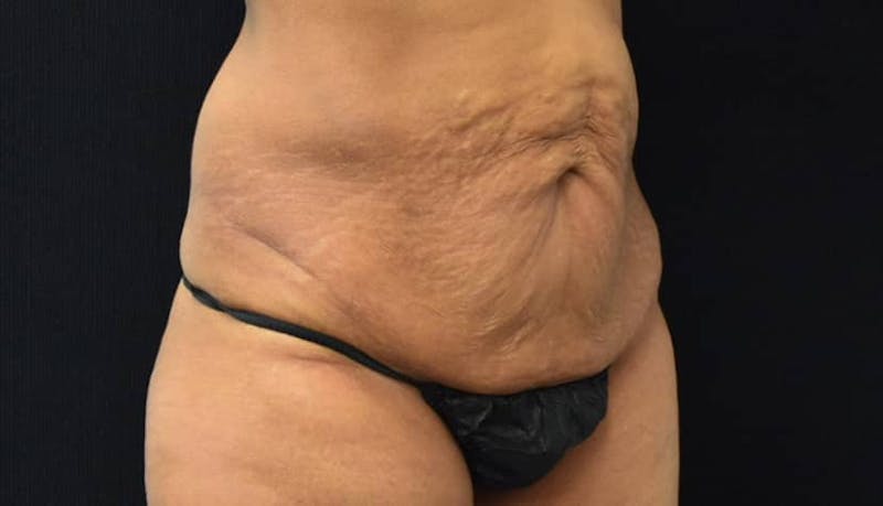 Abdominoplasty Before & After Gallery - Patient 102564048 - Image 3