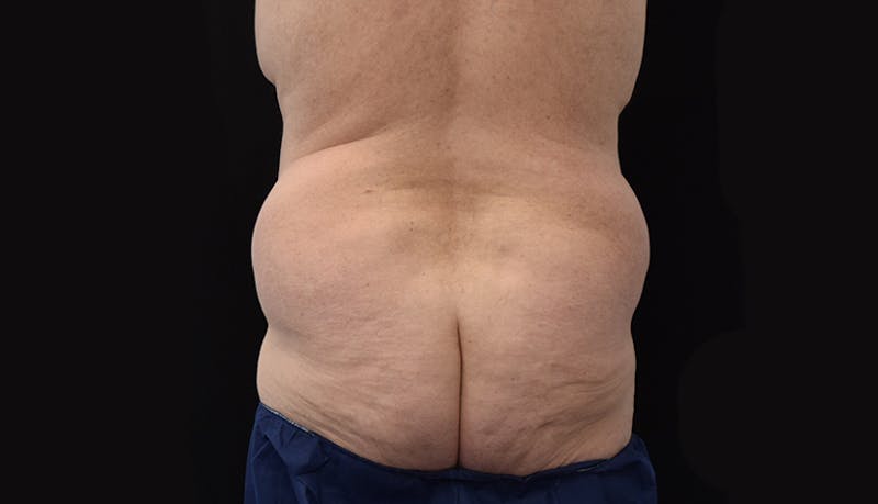 Massive Weight Loss Before & After Gallery - Patient 102563759 - Image 11