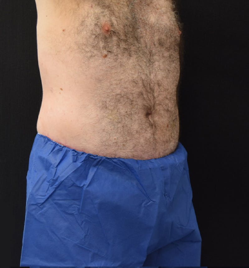 Male Lower Body Lift Before & After Gallery - Patient 148037529 - Image 8