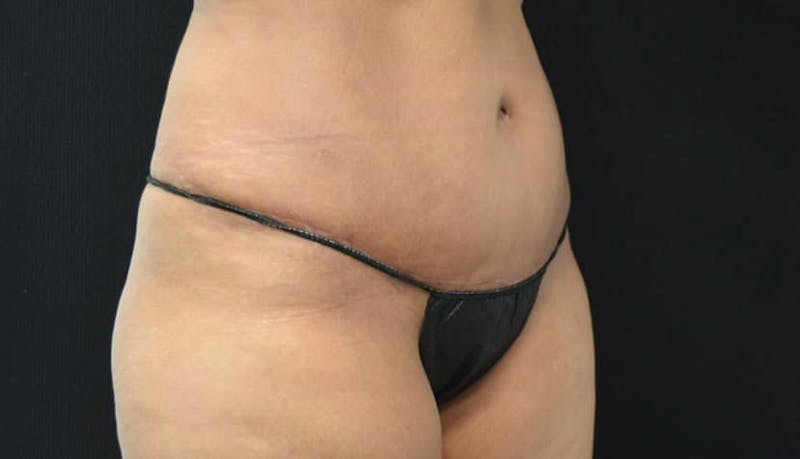 Abdominoplasty Before & After Gallery - Patient 102564048 - Image 4