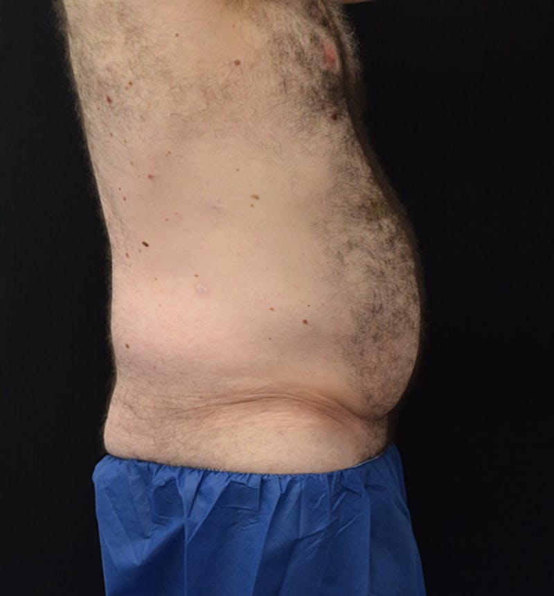 Male Lower Body Lift Before & After Gallery - Patient 148037529 - Image 9