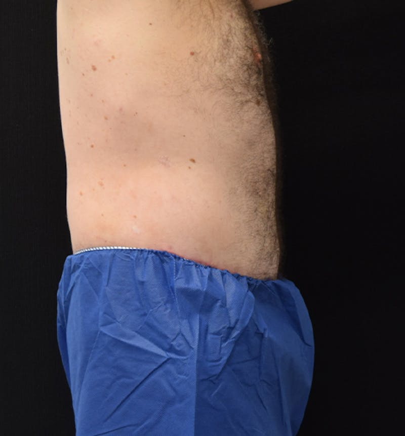 Male Lower Body Lift Before & After Gallery - Patient 148037529 - Image 10