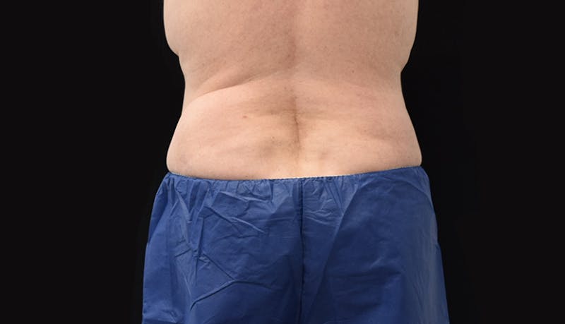 Massive Weight Loss Before & After Gallery - Patient 102563759 - Image 12