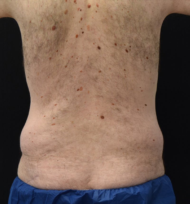 Lower Body Lift Before & After Gallery - Patient 148037529 - Image 11