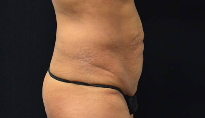 Abdominoplasty Before & After Gallery - Patient 102564048 - Image 5