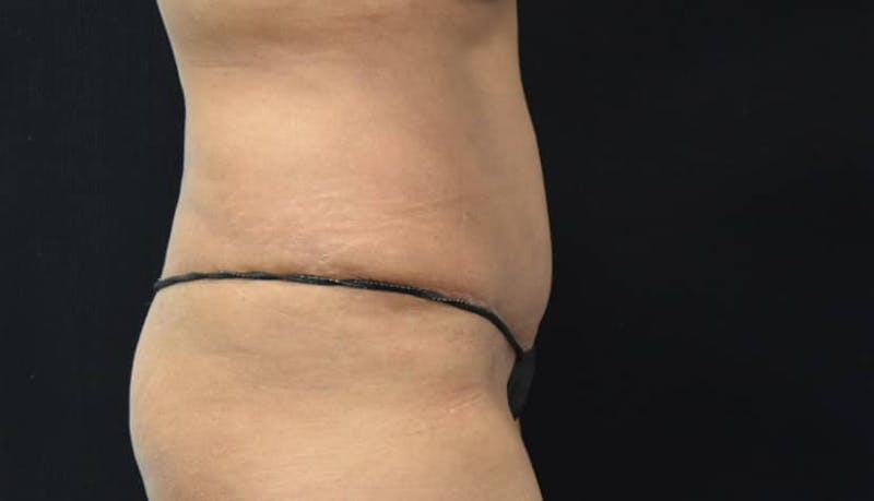 Abdominoplasty Before & After Gallery - Patient 102564048 - Image 6