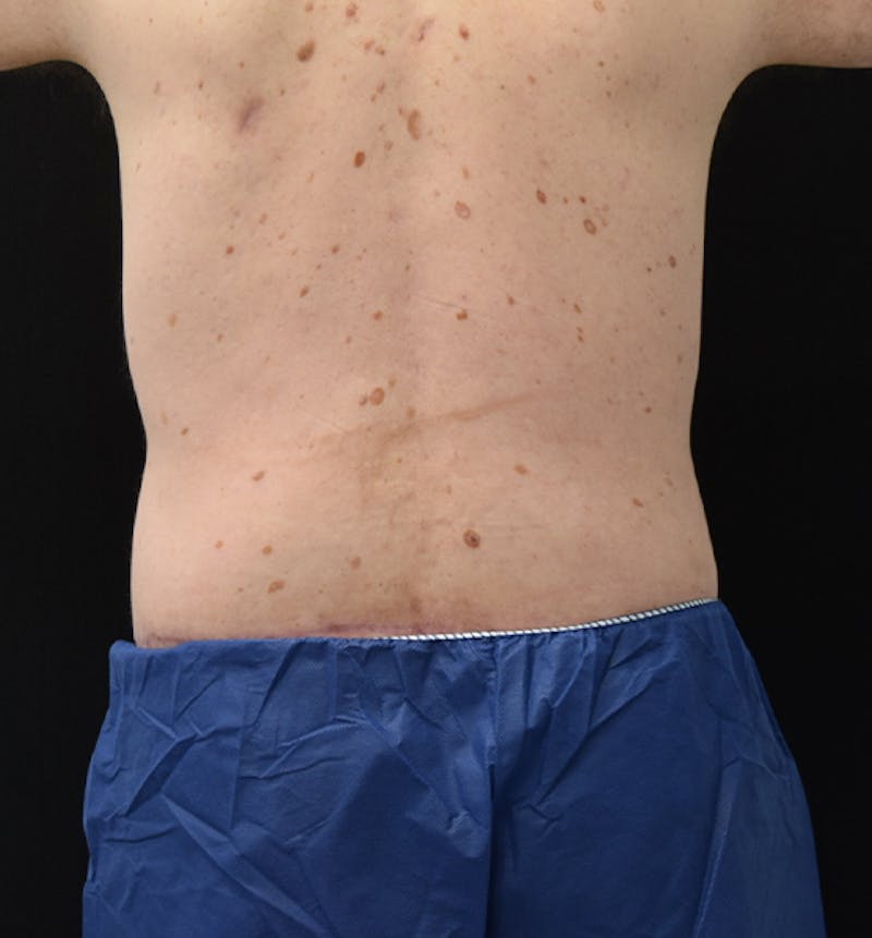 Male Lower Body Lift Before & After Gallery - Patient 148037529 - Image 12