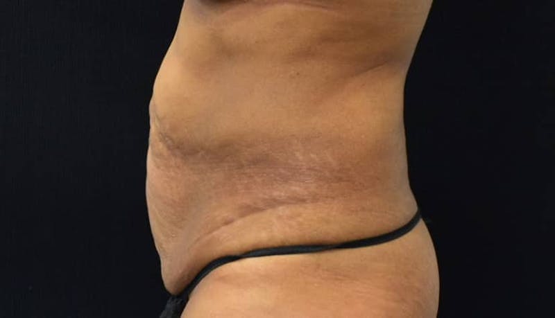 Abdominoplasty Before & After Gallery - Patient 102564048 - Image 7