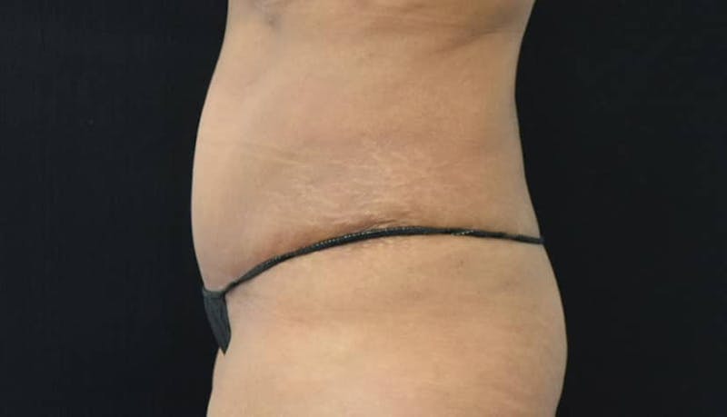 Abdominoplasty Before & After Gallery - Patient 102564048 - Image 8