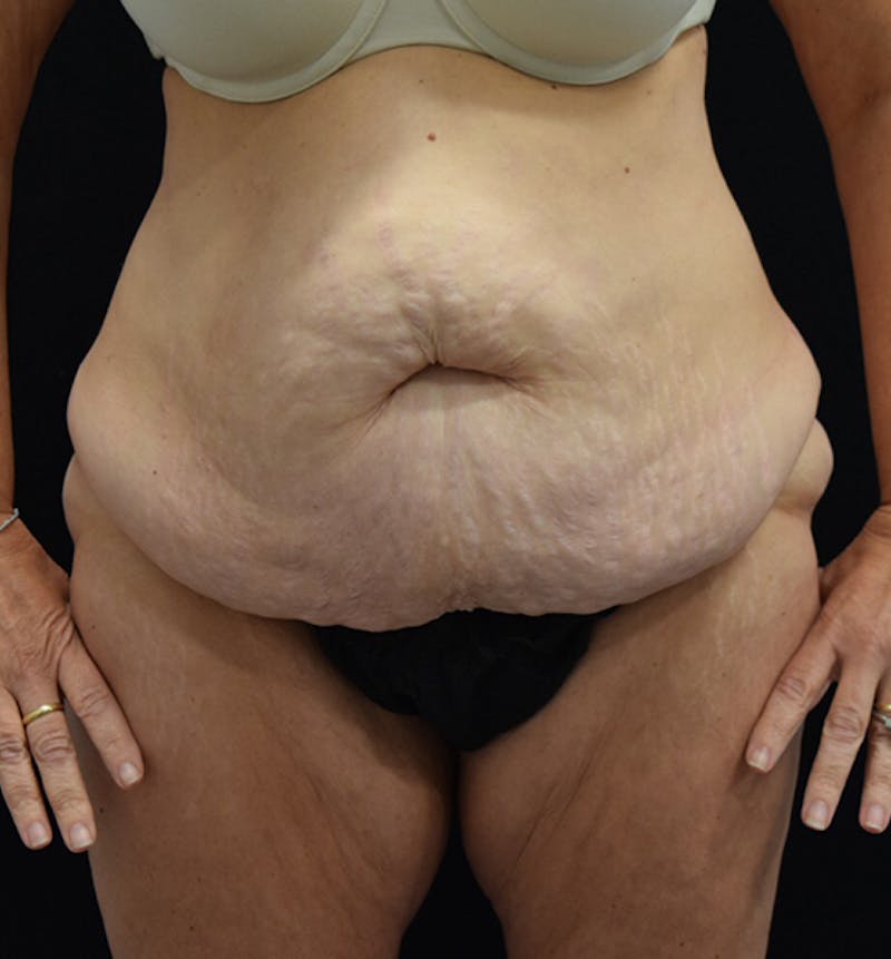 Lower Body Lift Before & After Gallery - Patient 102564053 - Image 1