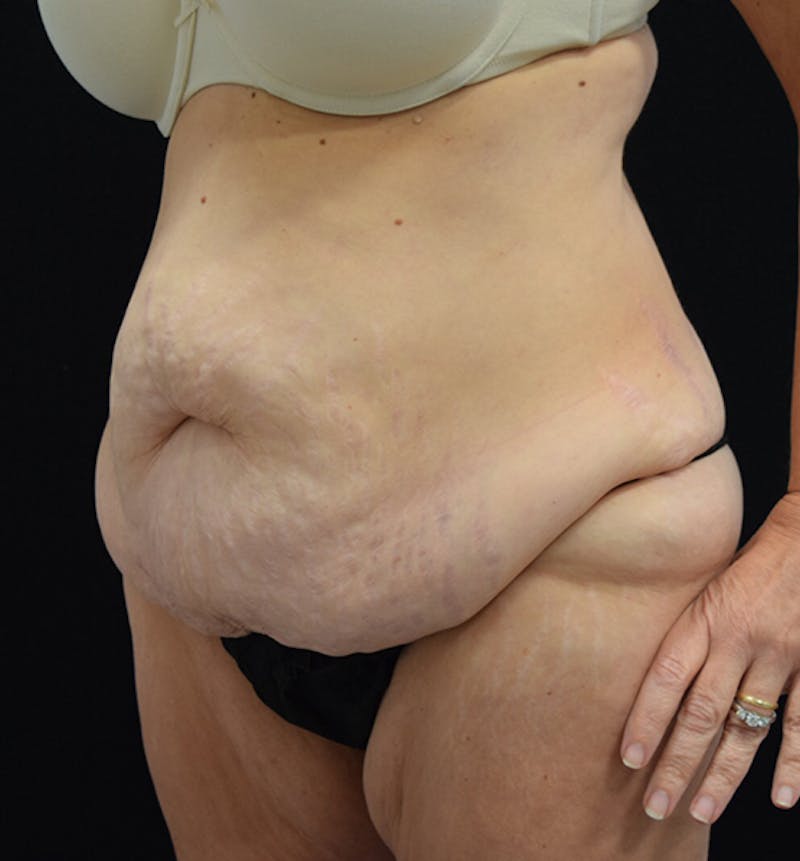 Lower Body Lift Before & After Gallery - Patient 102564053 - Image 3