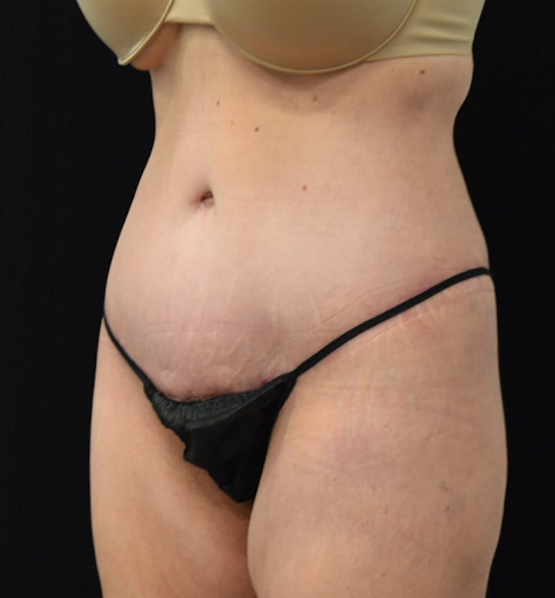 Lower Body Lift Before & After Gallery - Patient 102564053 - Image 4