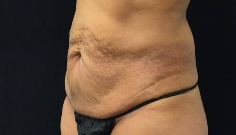 Abdominoplasty Before & After Gallery - Patient 102564048 - Image 9