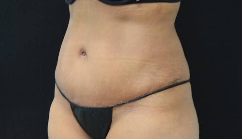 Abdominoplasty Before & After Gallery - Patient 102564048 - Image 10