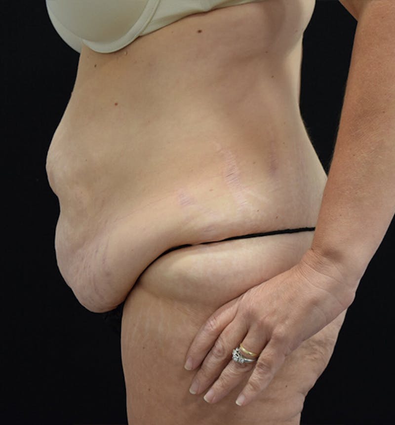 Lower Body Lift Before & After Gallery - Patient 102564053 - Image 5