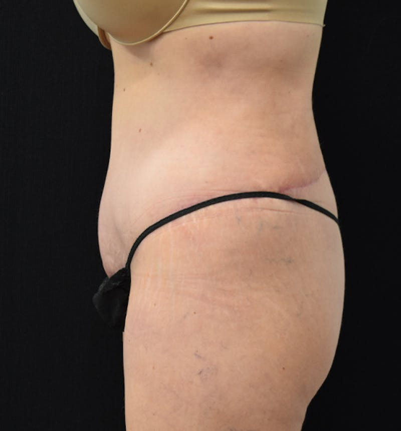 Lower Body Lift Gallery - Patient 102564053 - Image 6
