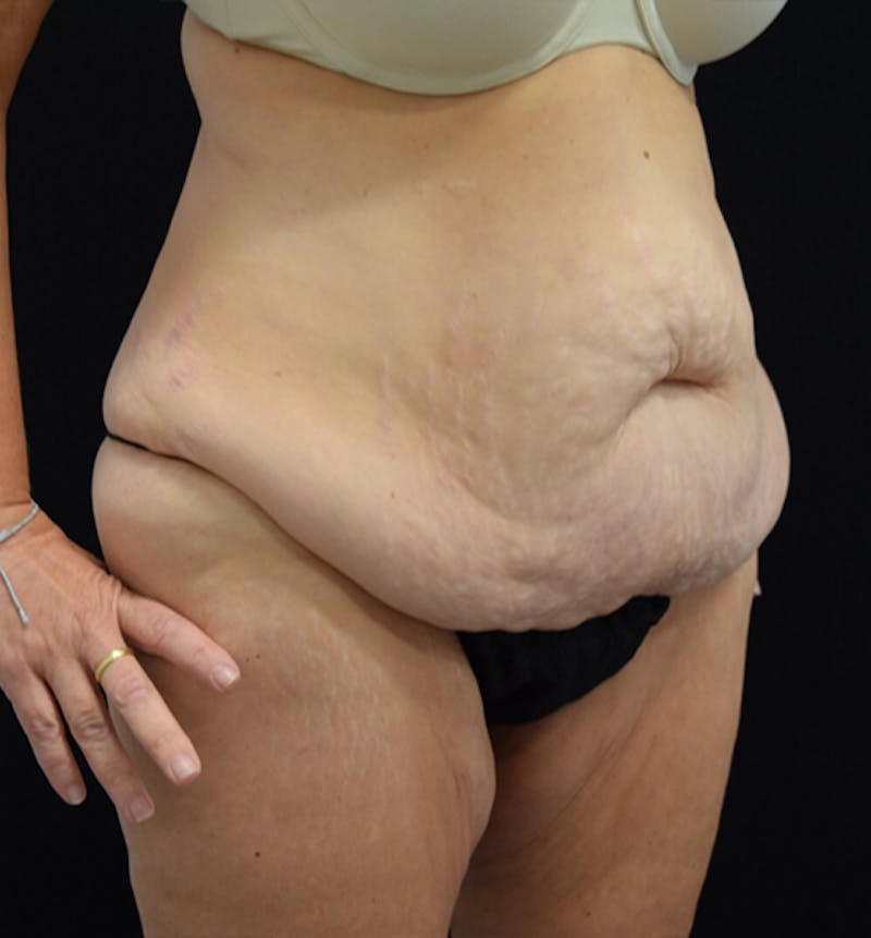 Lower Body Lift Before & After Gallery - Patient 102564053 - Image 7