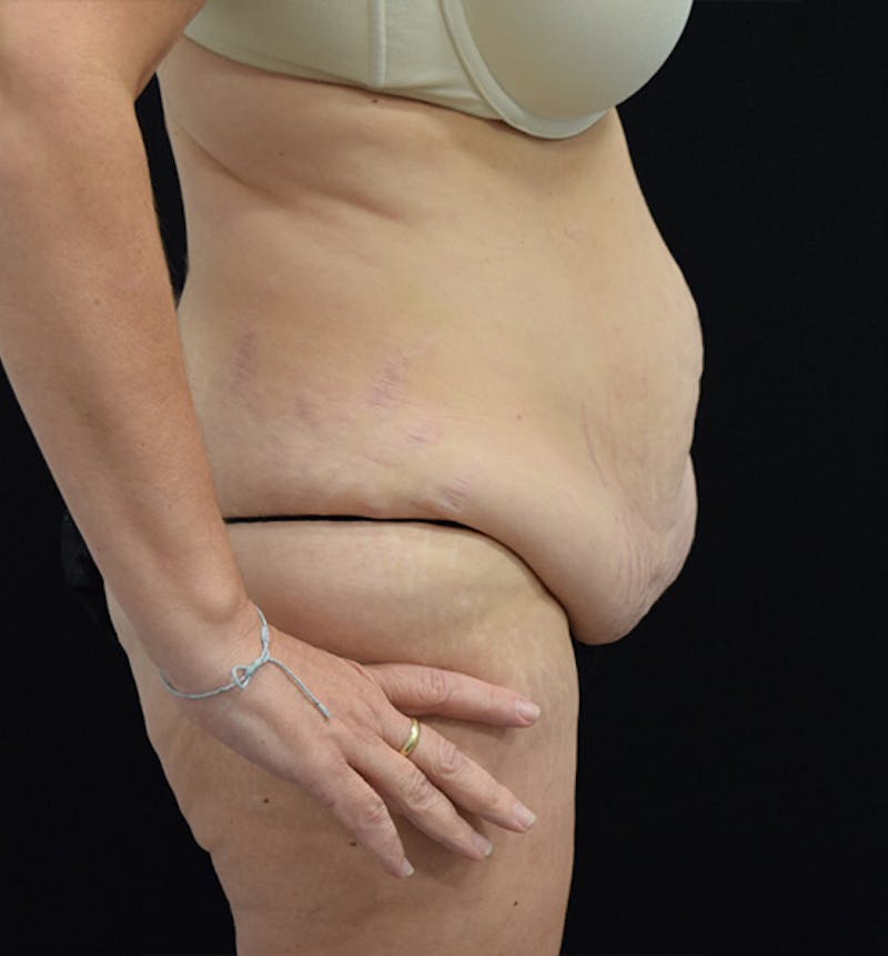 Lower Body Lift Before & After Gallery - Patient 102564053 - Image 9