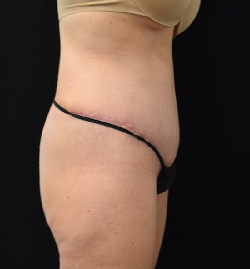 Lower Body Lift Before & After Gallery - Patient 102564053 - Image 10