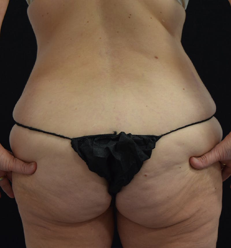 Lower Body Lift Before & After Gallery - Patient 102564053 - Image 11
