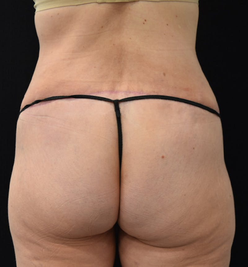 Lower Body Lift Before & After Gallery - Patient 102564053 - Image 12