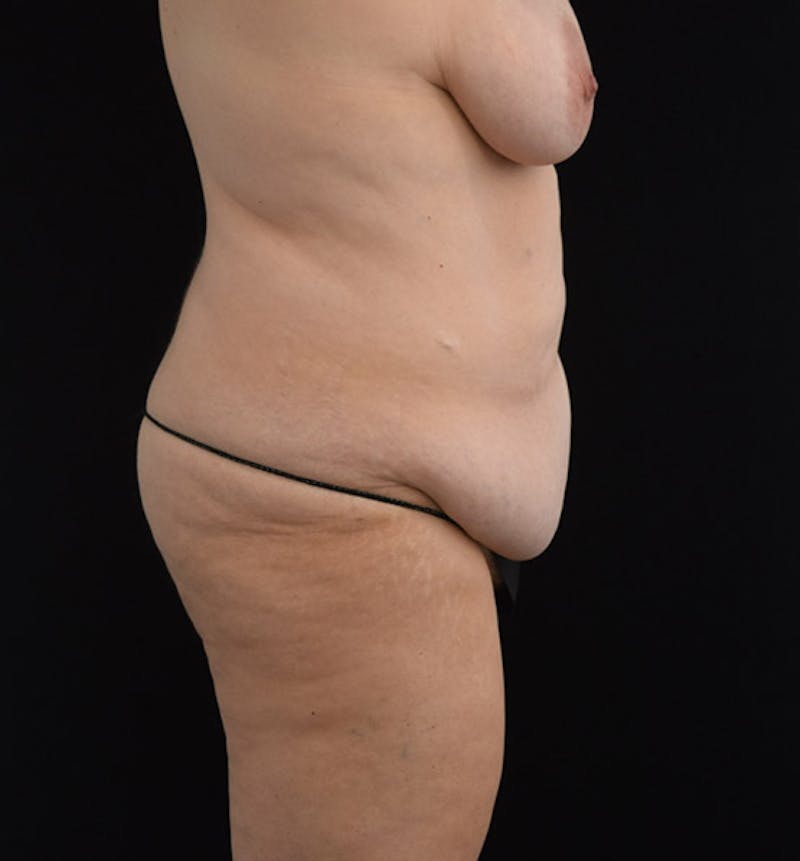 Lower Body Lift Before & After Gallery - Patient 102564072 - Image 5