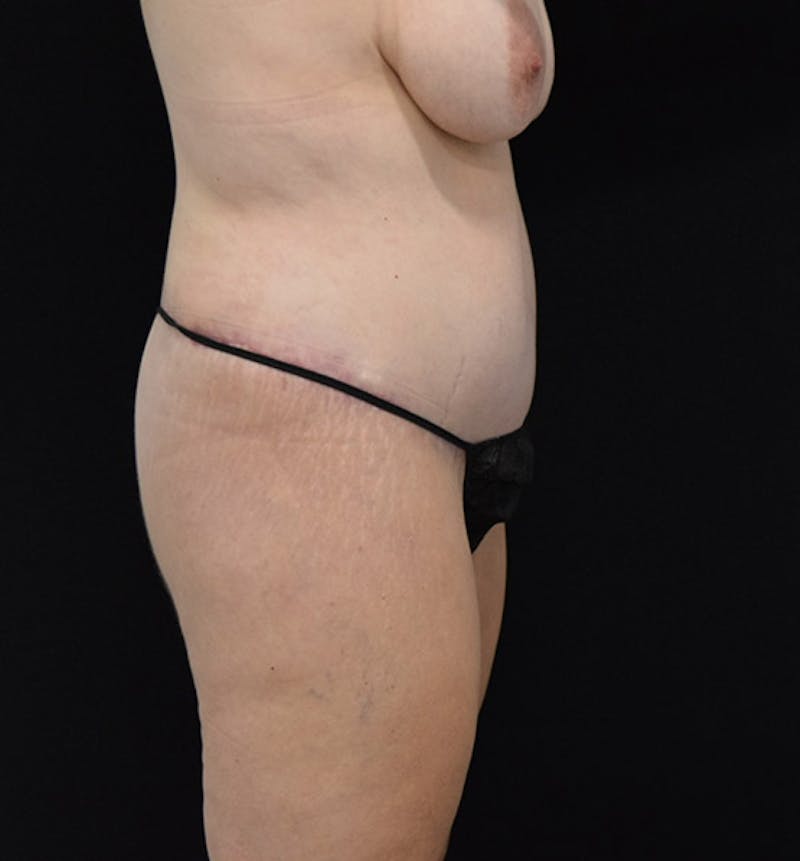 Lower Body Lift Before & After Gallery - Patient 102564072 - Image 6