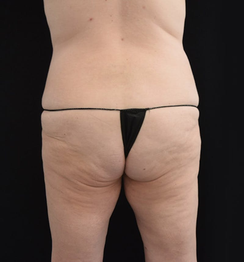 Lower Body Lift Before & After Gallery - Patient 102564072 - Image 9