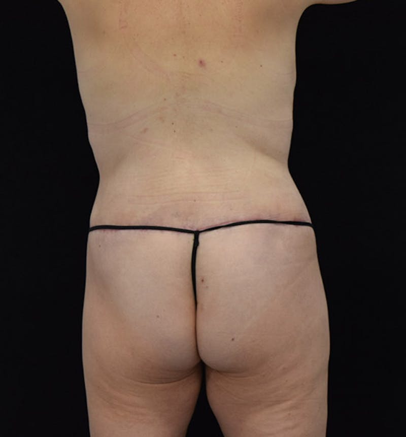 Lower Body Lift Before & After Gallery - Patient 102564072 - Image 10