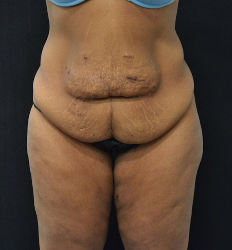 Lower Body Lift Before & After Gallery - Patient 102564093 - Image 1