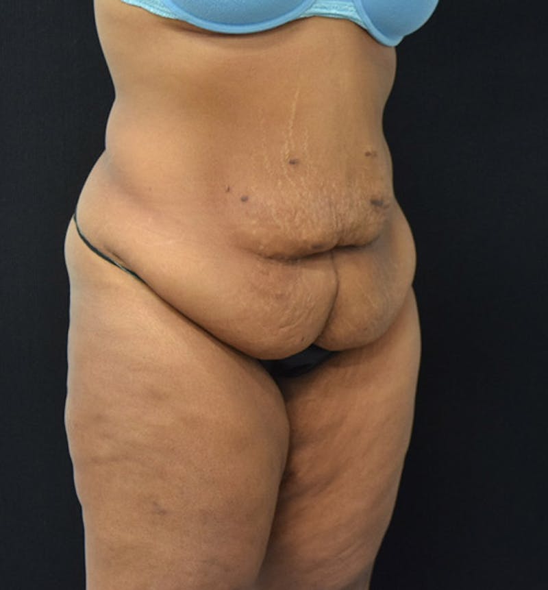 Lower Body Lift Before & After Gallery - Patient 102564093 - Image 3