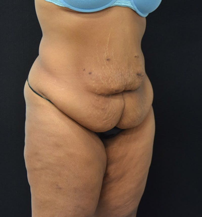 Lower Body Lift Gallery - Patient 102564093 - Image 3
