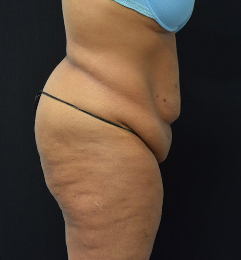 Lower Body Lift Before & After Gallery - Patient 102564093 - Image 5