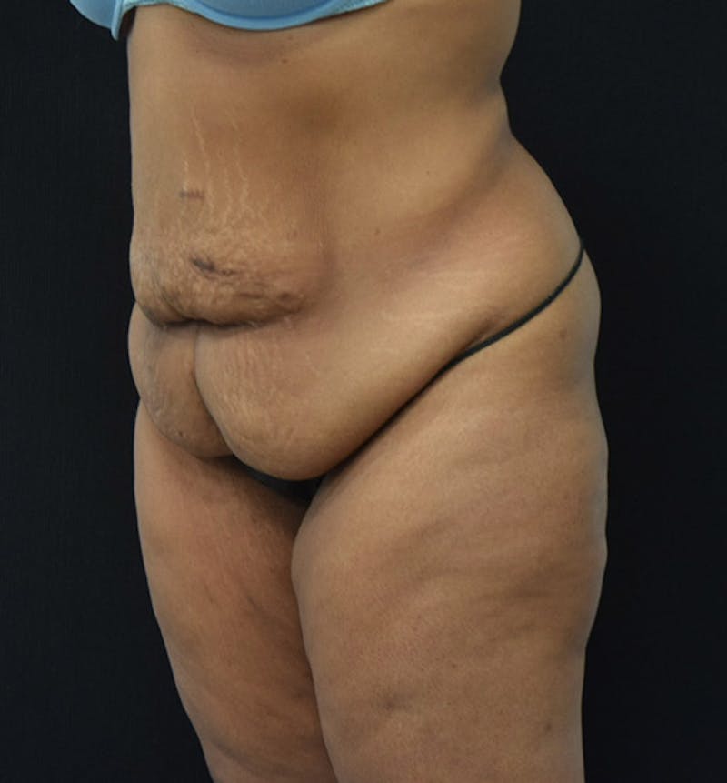 Lower Body Lift Before & After Gallery - Patient 102564093 - Image 7