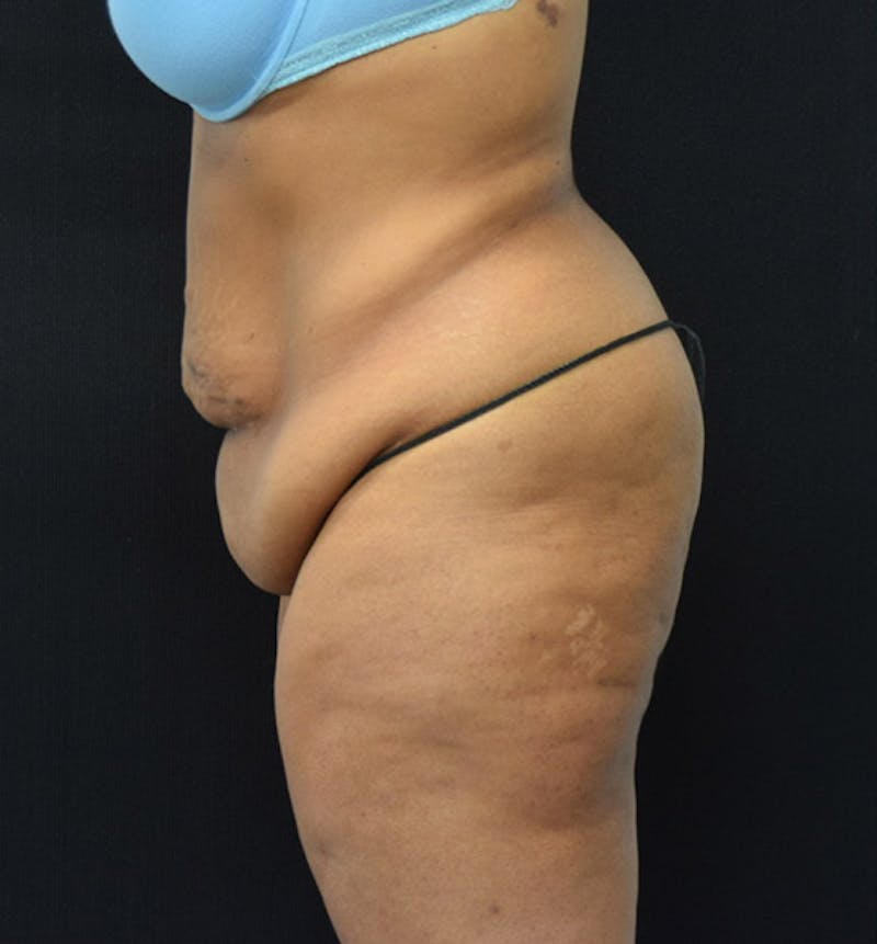 Lower Body Lift Before & After Gallery - Patient 102564093 - Image 9