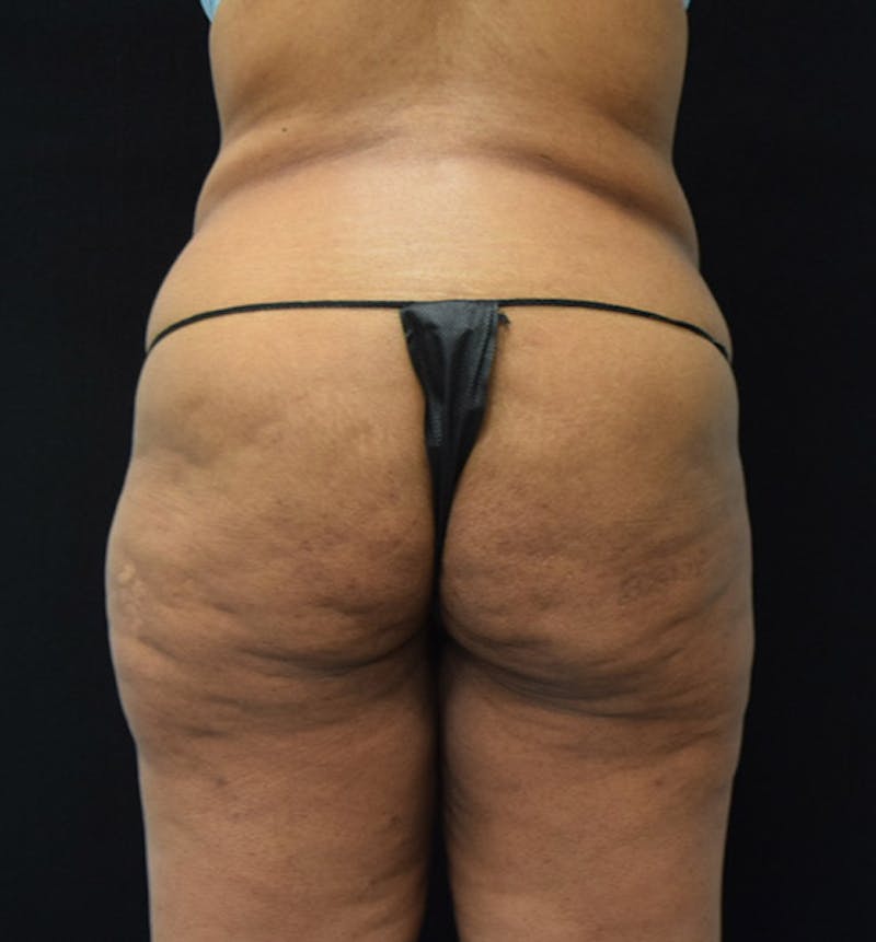 Lower Body Lift Before & After Gallery - Patient 102564093 - Image 11