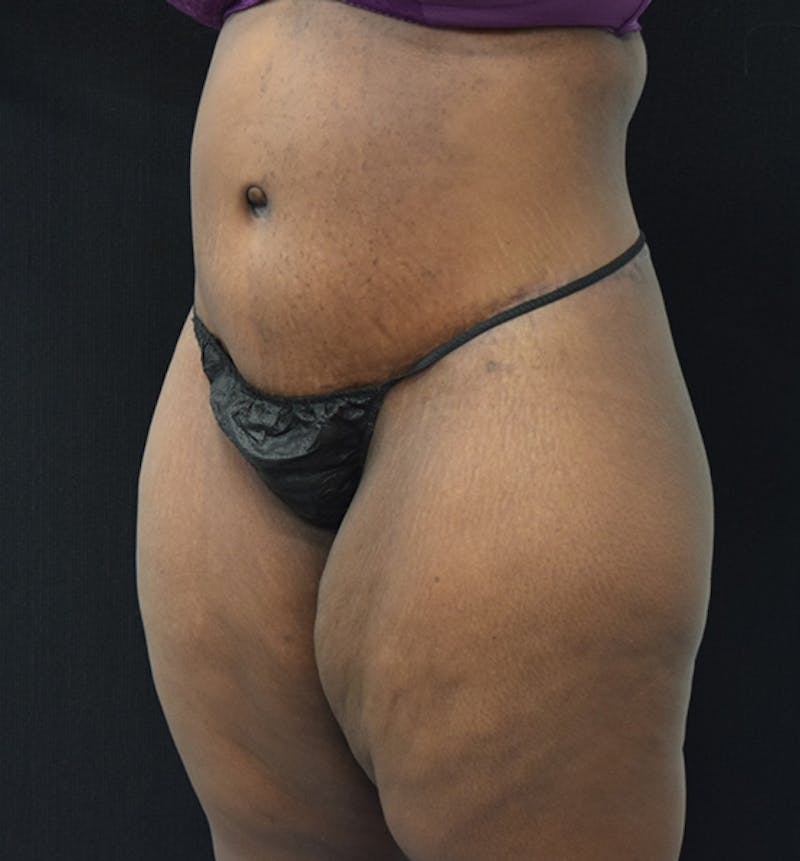 Lower Body Lift Before & After Gallery - Patient 102564110 - Image 4