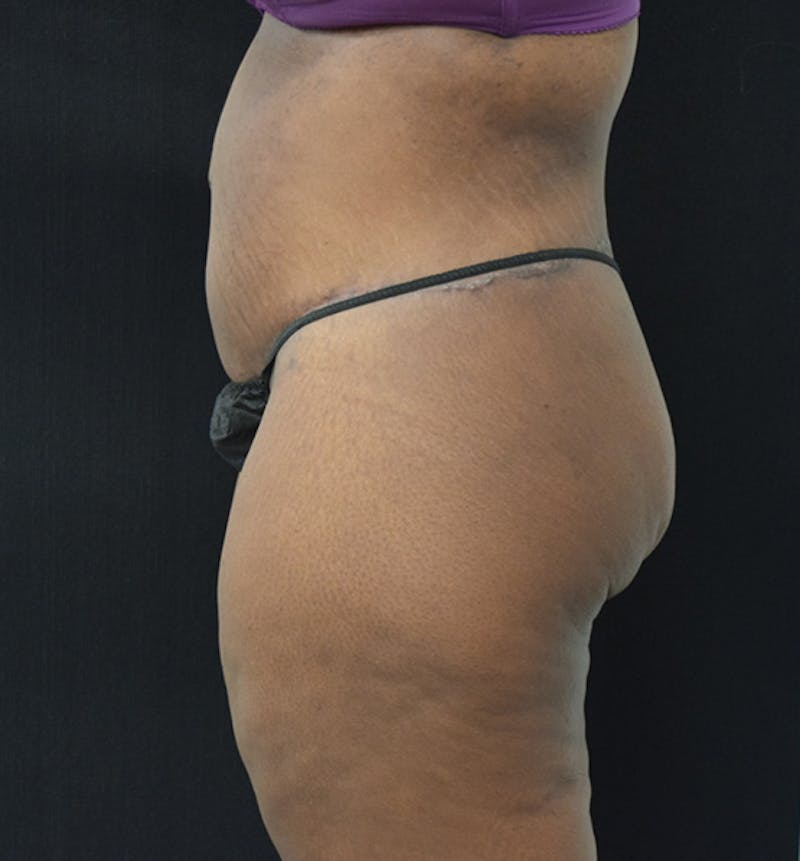 Lower Body Lift Before & After Gallery - Patient 102564110 - Image 6