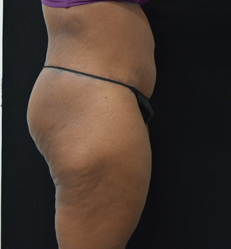 Lower Body Lift Before & After Gallery - Patient 102564110 - Image 10