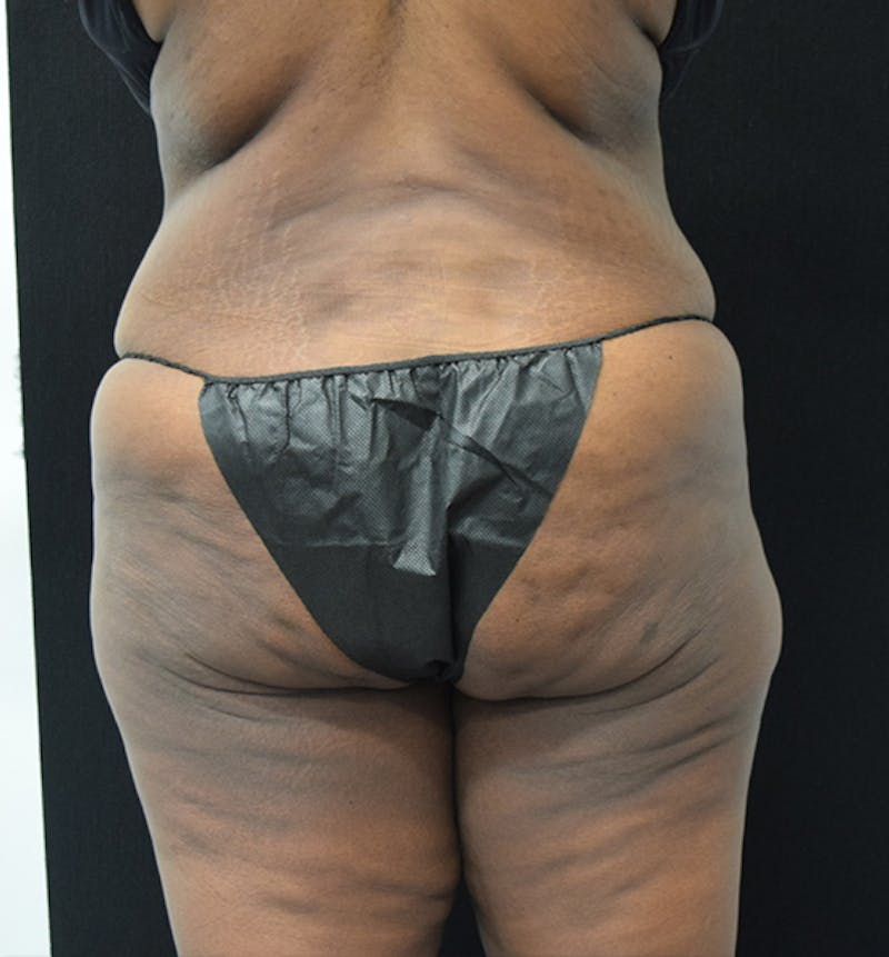 Lower Body Lift Before & After Gallery - Patient 102564110 - Image 11