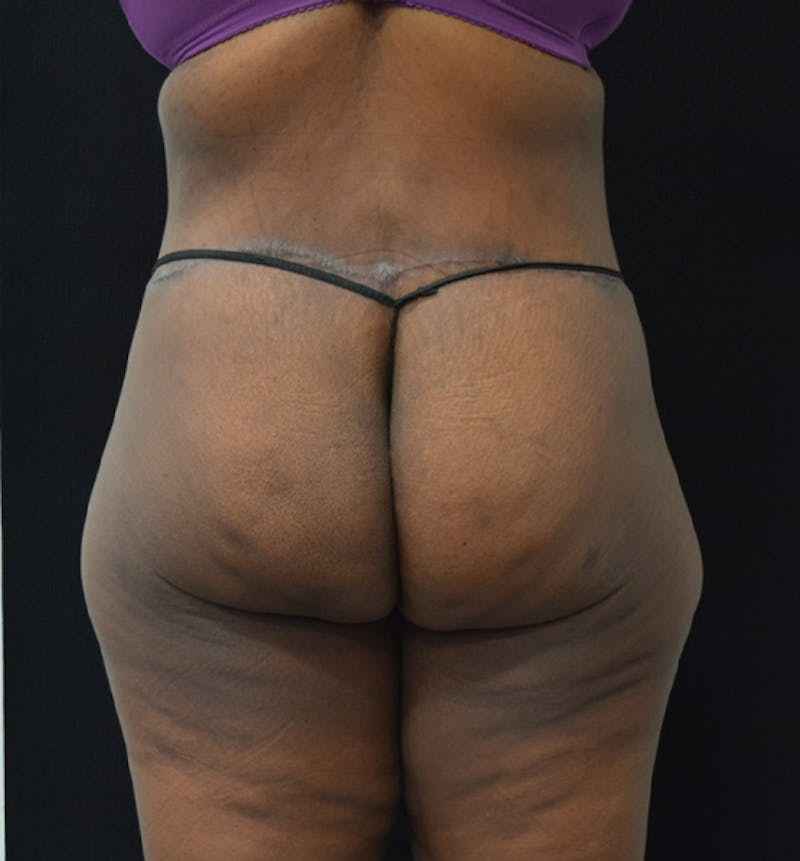 Lower Body Lift Before & After Gallery - Patient 102564110 - Image 12