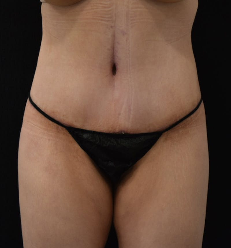 Lower Body Lift Before & After Gallery - Patient 102564121 - Image 2