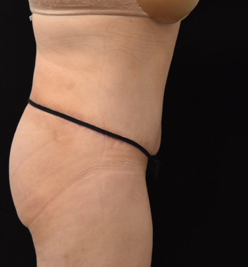 Lower Body Lift Before & After Gallery - Patient 102564121 - Image 6
