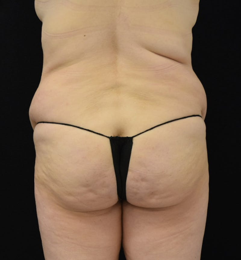 Lower Body Lift Before & After Gallery - Patient 102564121 - Image 7