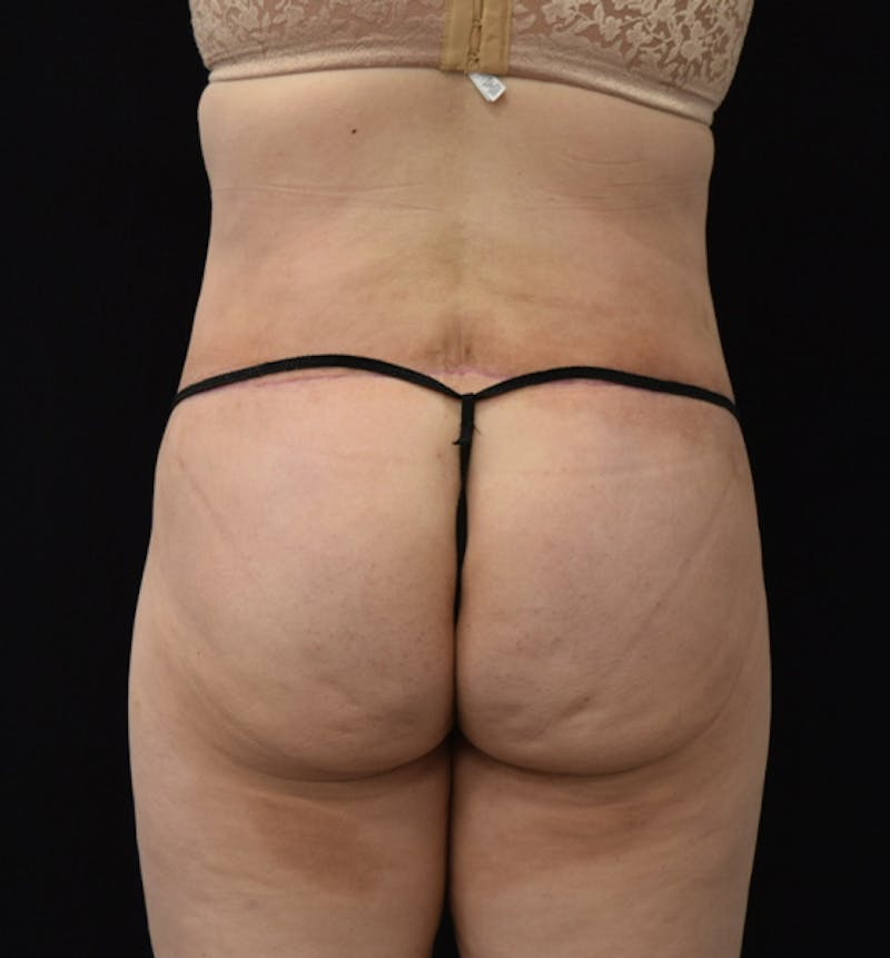 Lower Body Lift Before & After Gallery - Patient 102564121 - Image 8